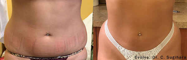 Before and After Image: Body Sculpting - front