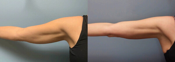 Before and After Image: Body Sculpting - front