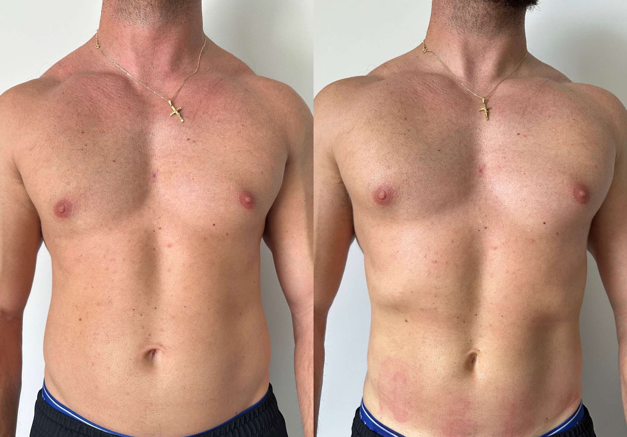Male patient, front view, before and after: chest and abdomen, wearing a gold chain and navy shorts